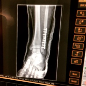 Cyborg Life - 9 Screws & A Plate